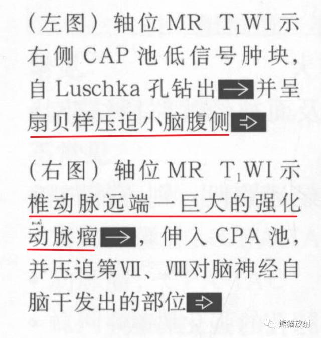 “成人桥小脑角肿块”的鉴别诊断