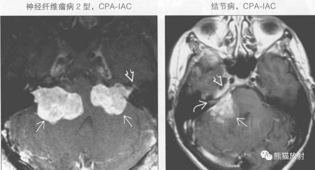 “成人桥小脑角肿块”的鉴别诊断