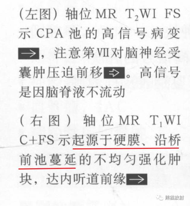 “成人桥小脑角肿块”的鉴别诊断