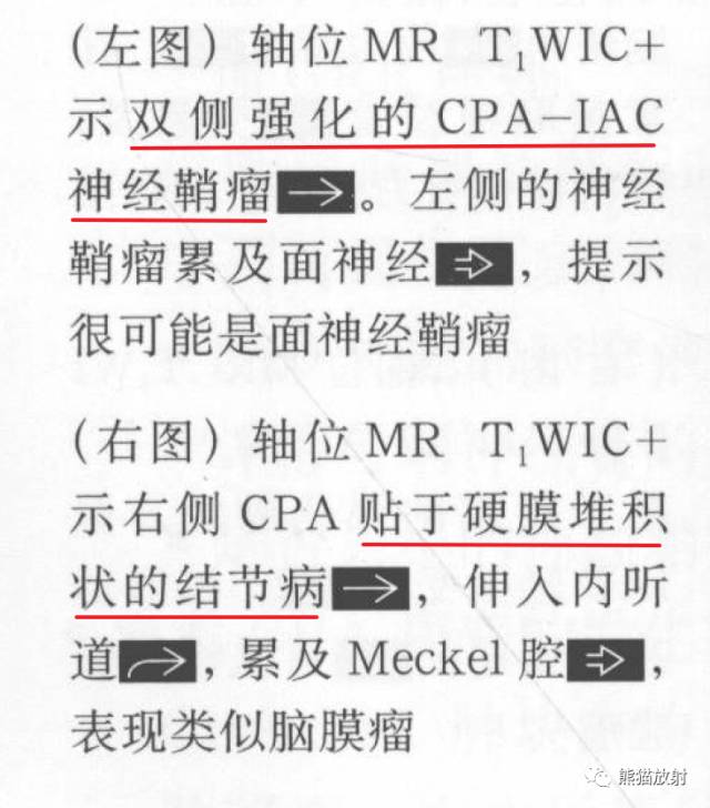 “成人桥小脑角肿块”的鉴别诊断