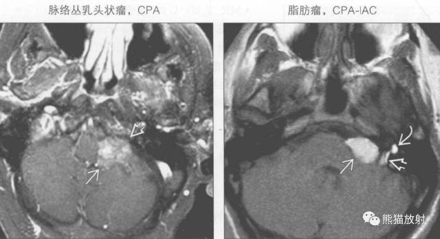 “成人桥小脑角肿块”的鉴别诊断