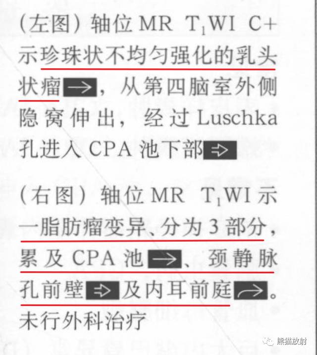 “成人桥小脑角肿块”的鉴别诊断