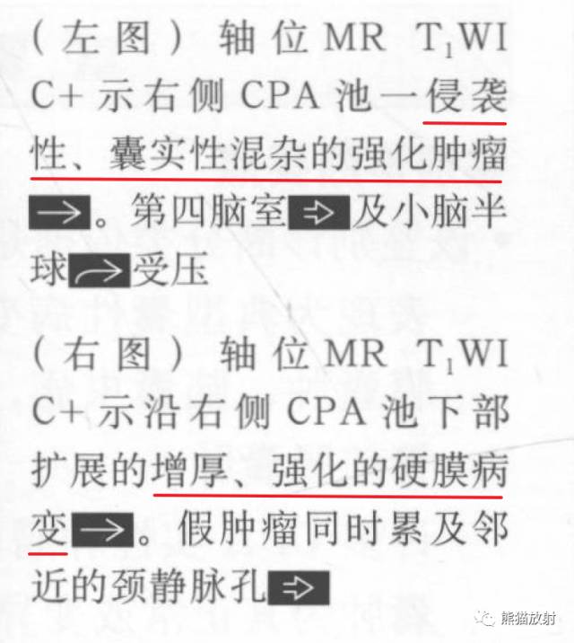 “成人桥小脑角肿块”的鉴别诊断