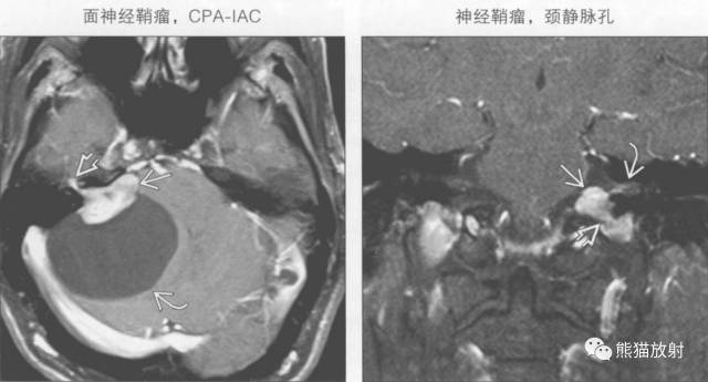 “成人桥小脑角肿块”的鉴别诊断