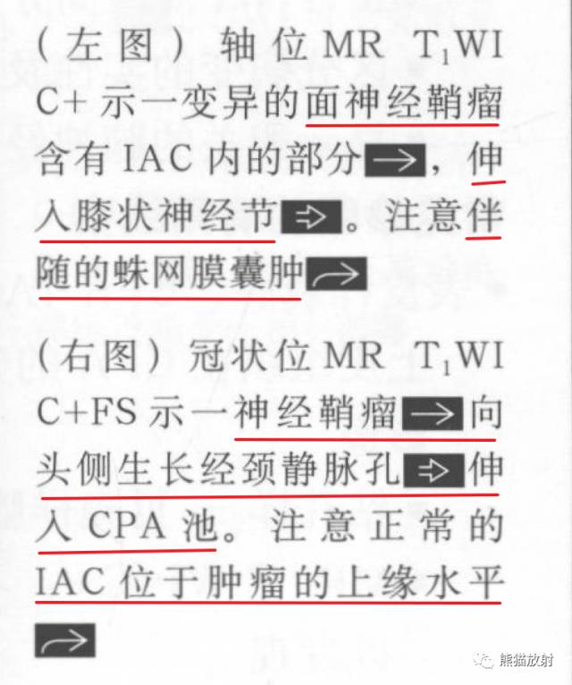 “成人桥小脑角肿块”的鉴别诊断