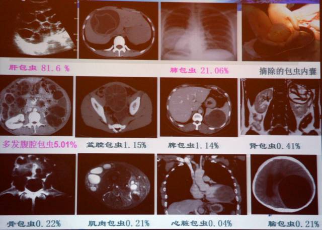 包虫病的影像诊断与鉴别 包虫病的影像诊断与鉴别