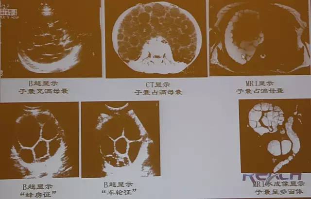 包虫病的影像诊断与鉴别 包虫病的影像诊断与鉴别
