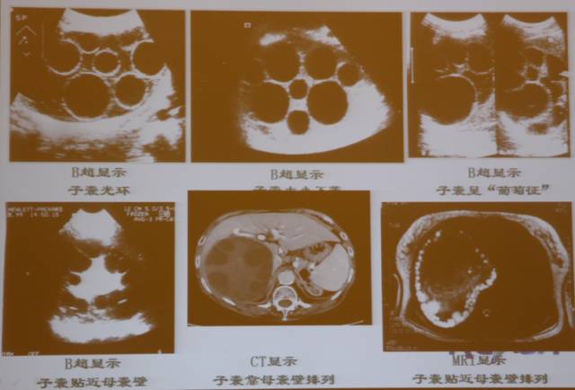 包虫病的影像诊断与鉴别 包虫病的影像诊断与鉴别