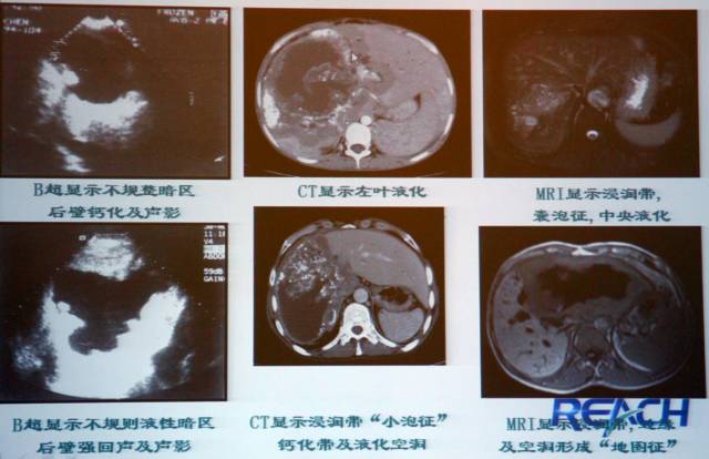 包虫病的影像诊断与鉴别 包虫病的影像诊断与鉴别