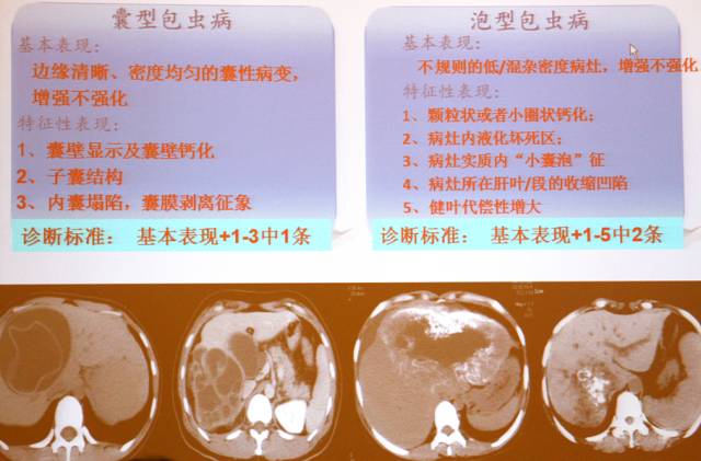 包虫病的影像诊断与鉴别 包虫病的影像诊断与鉴别