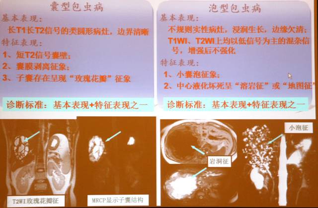 包虫病的影像诊断与鉴别 包虫病的影像诊断与鉴别