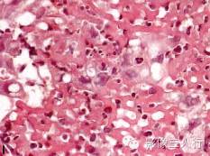 【病例】舌癌1例CT及MR影像表现分析 【病例】舌癌1例CT及MR影像表现分析