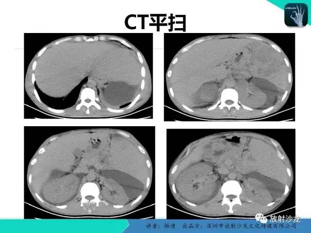 【病例】脾硬化性血管瘤1例CT影像表现与鉴别
