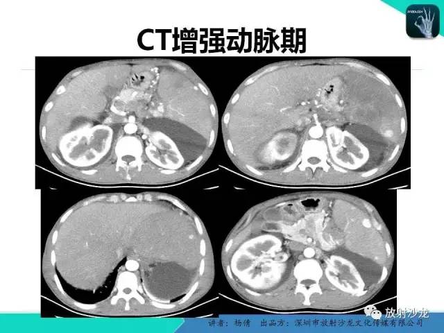 【病例】脾硬化性血管瘤1例CT影像表现与鉴别