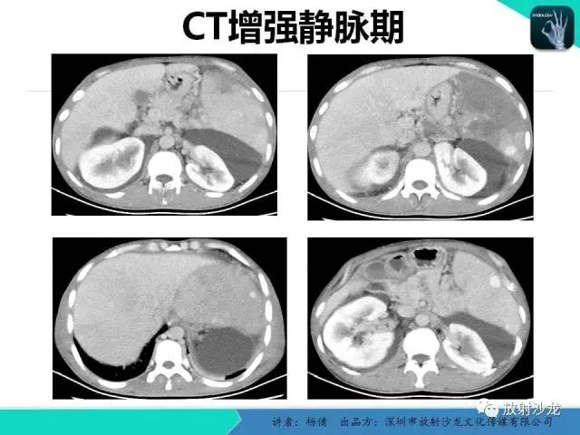 【病例】脾硬化性血管瘤1例CT影像表现与鉴别