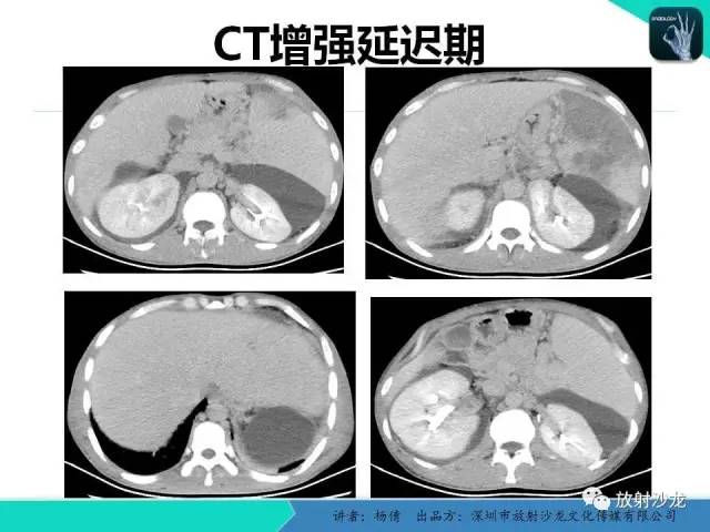 【病例】脾硬化性血管瘤1例CT影像表现与鉴别