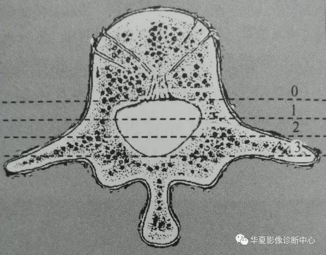 脊柱骨性损伤的这些细节,你都描述了吗? 脊柱骨性损伤的这些细节,你都描述了吗?