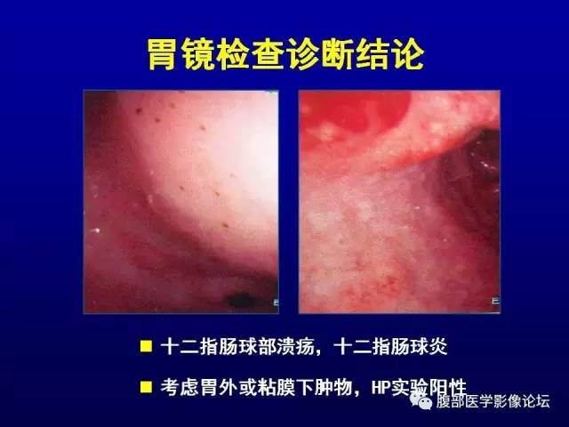 【病例】腹膜后副神经节瘤1例CT影像表现 【病例】腹膜后副神经节瘤1例CT影像表现