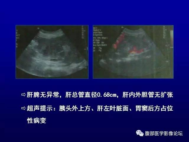 【病例】腹膜后副神经节瘤1例CT影像表现 【病例】腹膜后副神经节瘤1例CT影像表现