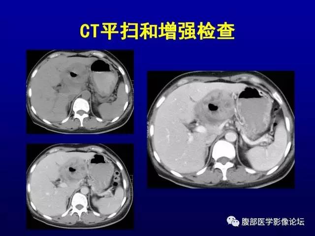 【病例】腹膜后副神经节瘤1例CT影像表现 【病例】腹膜后副神经节瘤1例CT影像表现