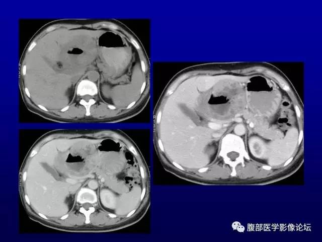 【病例】腹膜后副神经节瘤1例CT影像表现 【病例】腹膜后副神经节瘤1例CT影像表现