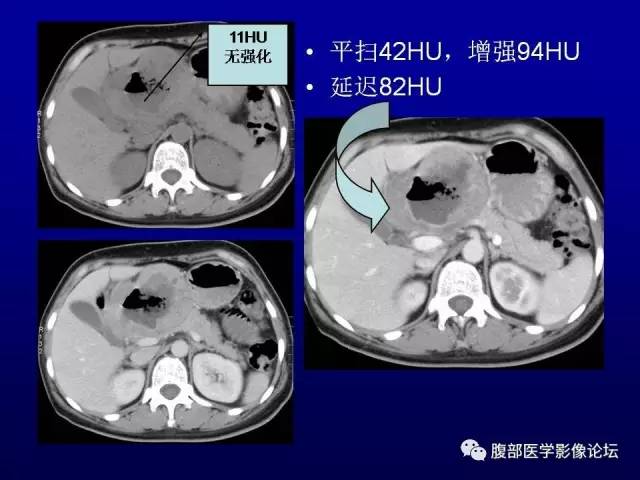 【病例】腹膜后副神经节瘤1例CT影像表现 【病例】腹膜后副神经节瘤1例CT影像表现