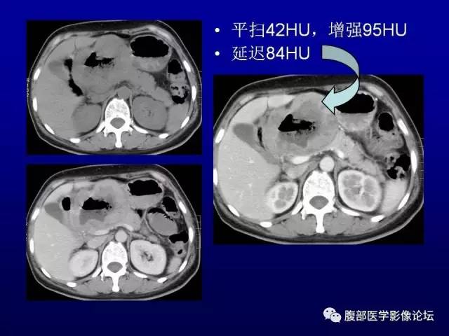 【病例】腹膜后副神经节瘤1例CT影像表现 【病例】腹膜后副神经节瘤1例CT影像表现
