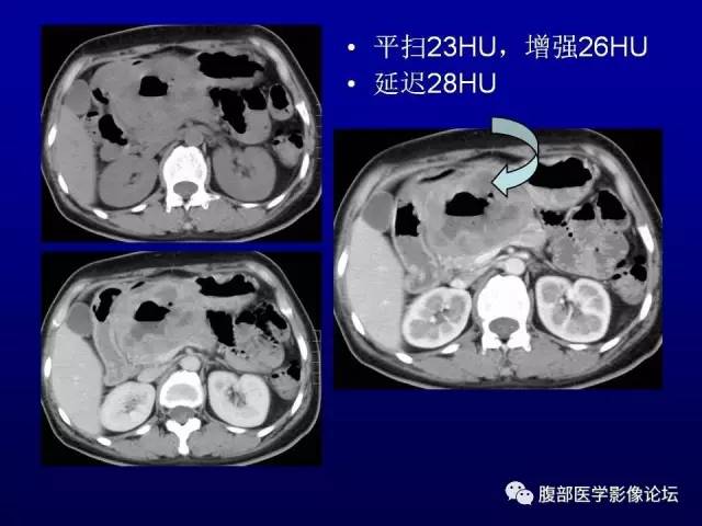 【病例】腹膜后副神经节瘤1例CT影像表现 【病例】腹膜后副神经节瘤1例CT影像表现