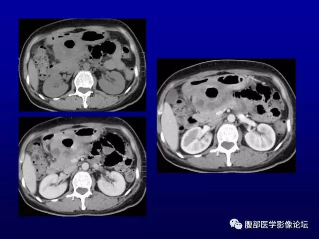 【病例】腹膜后副神经节瘤1例CT影像表现 【病例】腹膜后副神经节瘤1例CT影像表现