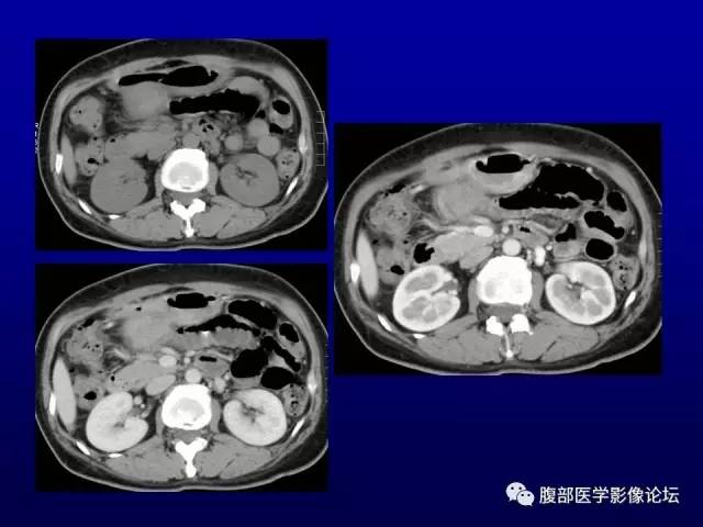 【病例】腹膜后副神经节瘤1例CT影像表现 【病例】腹膜后副神经节瘤1例CT影像表现