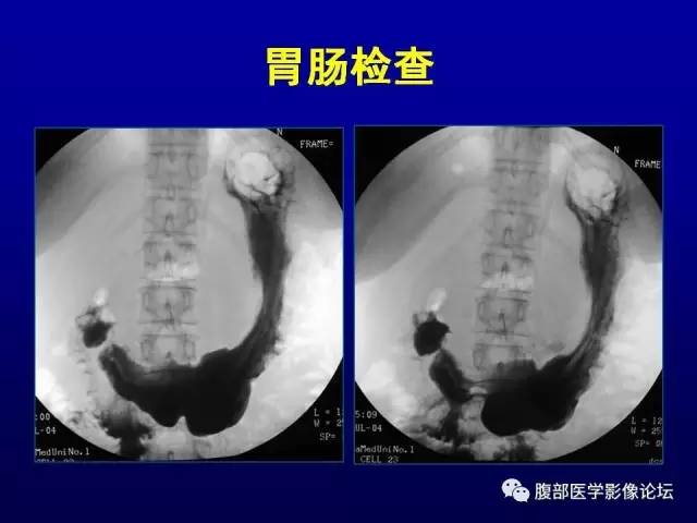 【病例】腹膜后副神经节瘤1例CT影像表现 【病例】腹膜后副神经节瘤1例CT影像表现