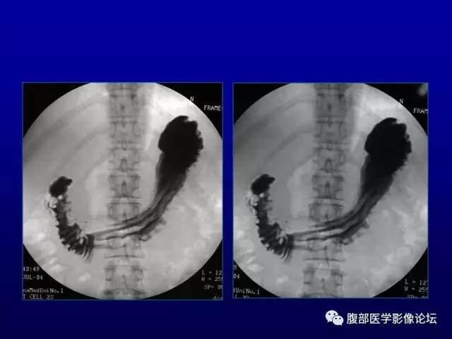 【病例】腹膜后副神经节瘤1例CT影像表现 【病例】腹膜后副神经节瘤1例CT影像表现