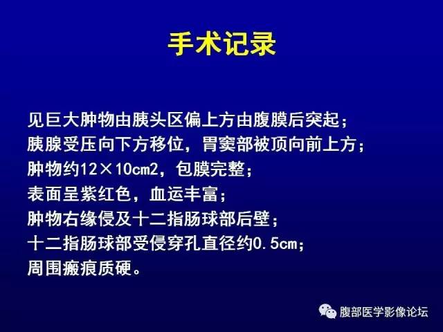 【病例】腹膜后副神经节瘤1例CT影像表现 【病例】腹膜后副神经节瘤1例CT影像表现