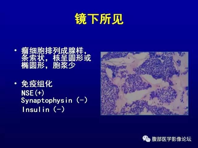 【病例】腹膜后副神经节瘤1例CT影像表现 【病例】腹膜后副神经节瘤1例CT影像表现