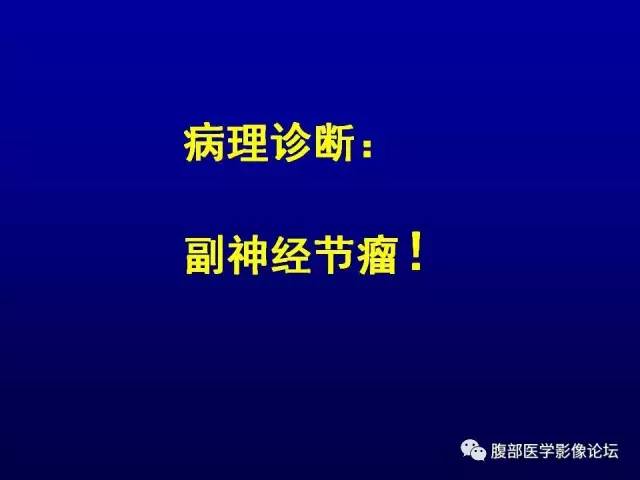 【病例】腹膜后副神经节瘤1例CT影像表现 【病例】腹膜后副神经节瘤1例CT影像表现