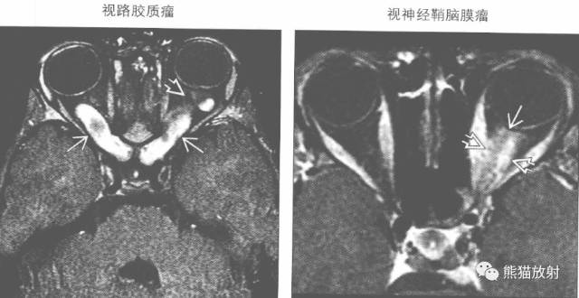 “肌锥内间隙肿块”的鉴别诊断