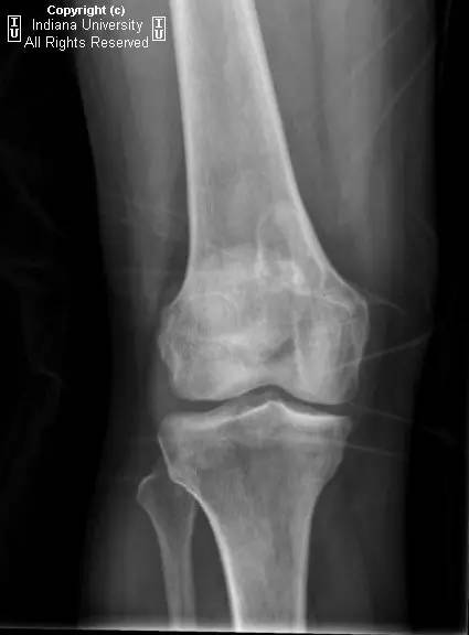 【病例】股骨非骨化纤维瘤1例X线MR影像表现 【病例】股骨非骨化纤维瘤1例X线MR影像表现