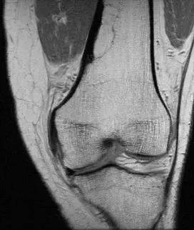 【病例】股骨非骨化纤维瘤1例X线MR影像表现 【病例】股骨非骨化纤维瘤1例X线MR影像表现