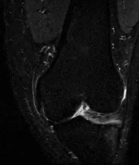 【病例】股骨非骨化纤维瘤1例X线MR影像表现 【病例】股骨非骨化纤维瘤1例X线MR影像表现