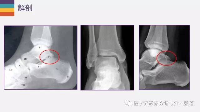 【PPT】三角籽骨综合征