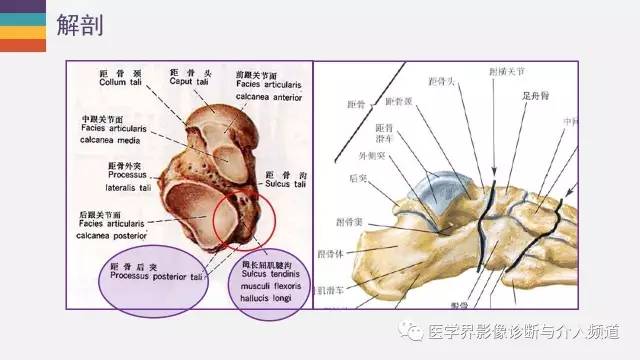 【PPT】三角籽骨综合征