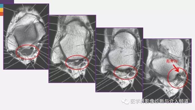 【PPT】三角籽骨综合征