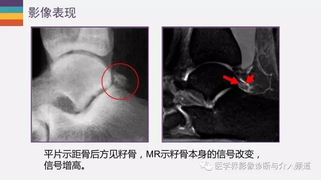 【PPT】三角籽骨综合征