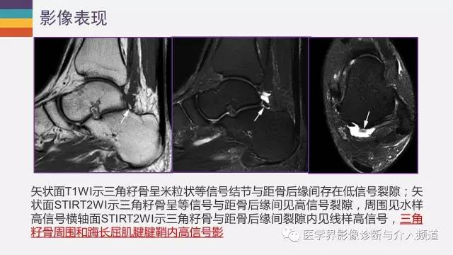 【PPT】三角籽骨综合征