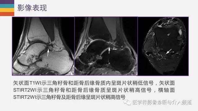 【PPT】三角籽骨综合征