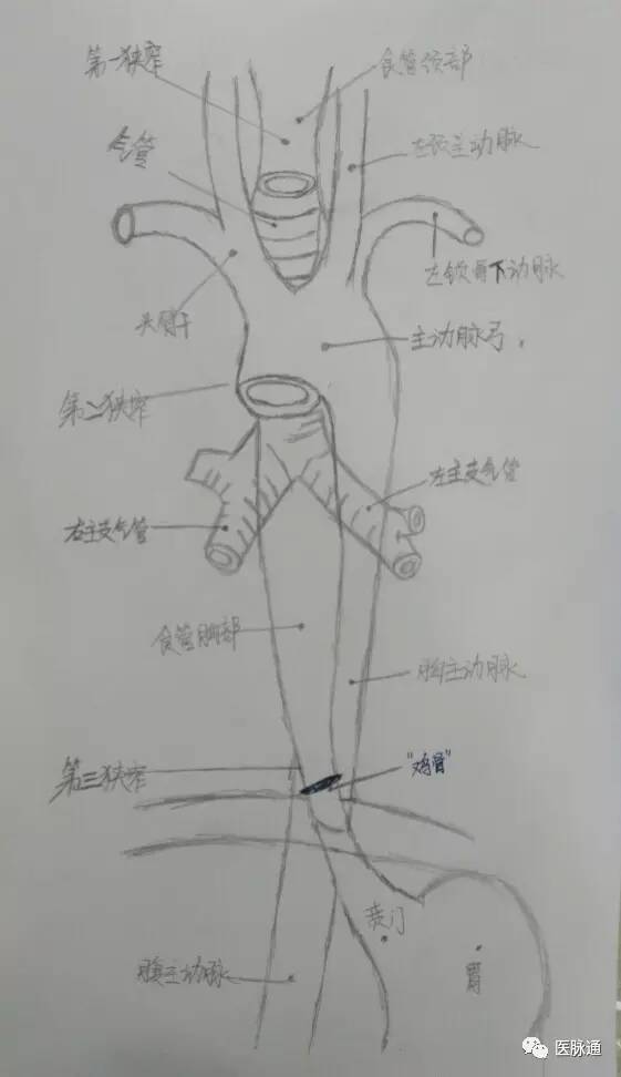 一根价值万元的鸡骨头引发的“漏诊”病例 一根价值万元的鸡骨头引发的“漏诊”病例