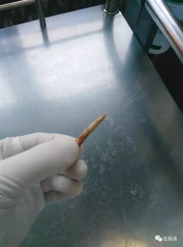 一根价值万元的鸡骨头引发的“漏诊”病例 一根价值万元的鸡骨头引发的“漏诊”病例