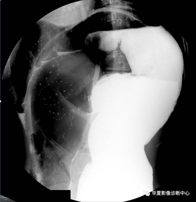 【PPT】成人先天性巨结肠症