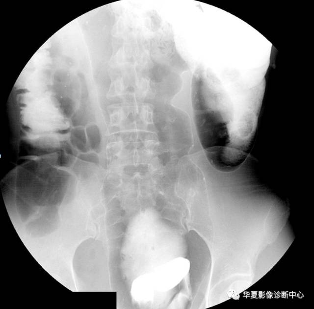 【PPT】成人先天性巨结肠症