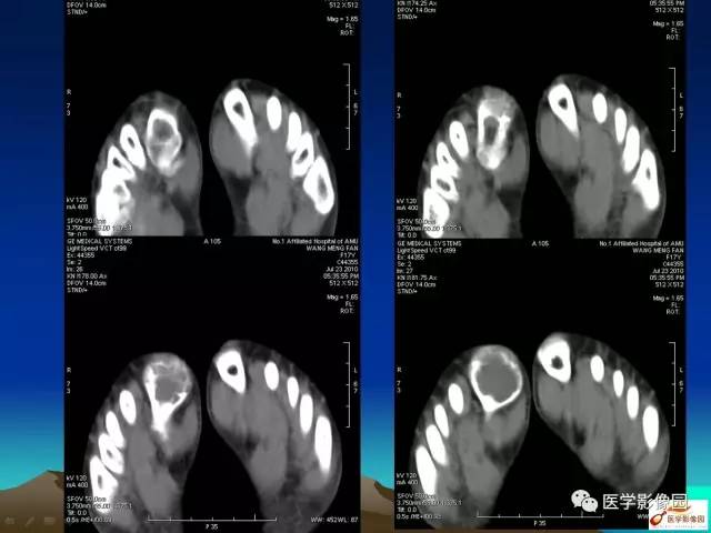 【病例】趾骨骨巨细胞瘤1例CT影像表现 【病例】趾骨骨巨细胞瘤1例CT影像表现